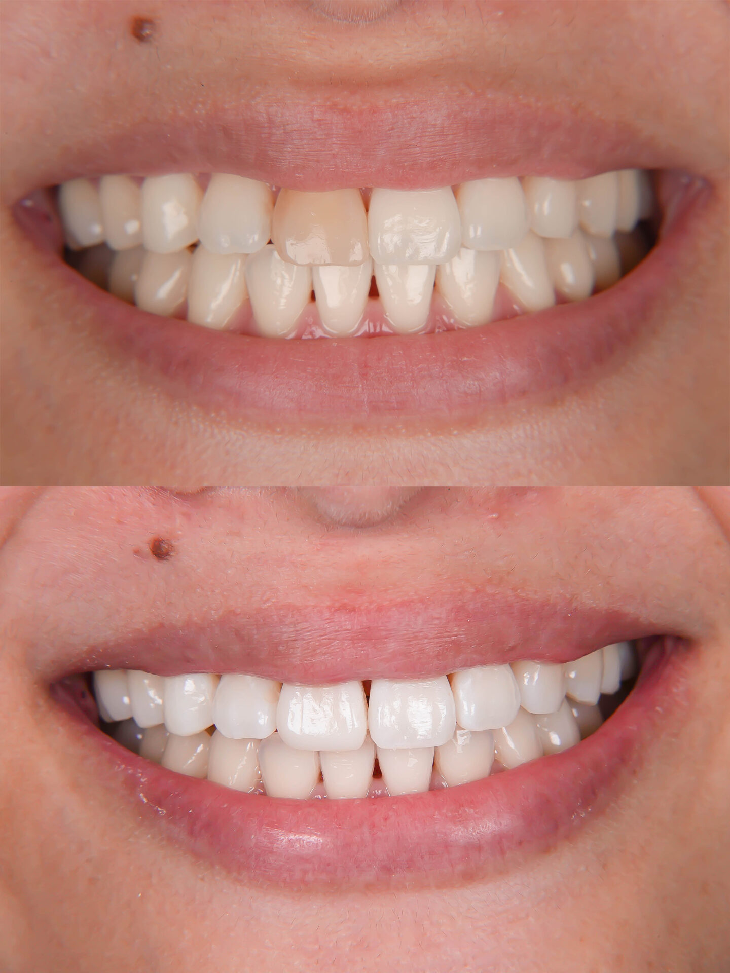 前歯が変色している状態に対してダイレクトボンディングにて対応した症例治療方法14